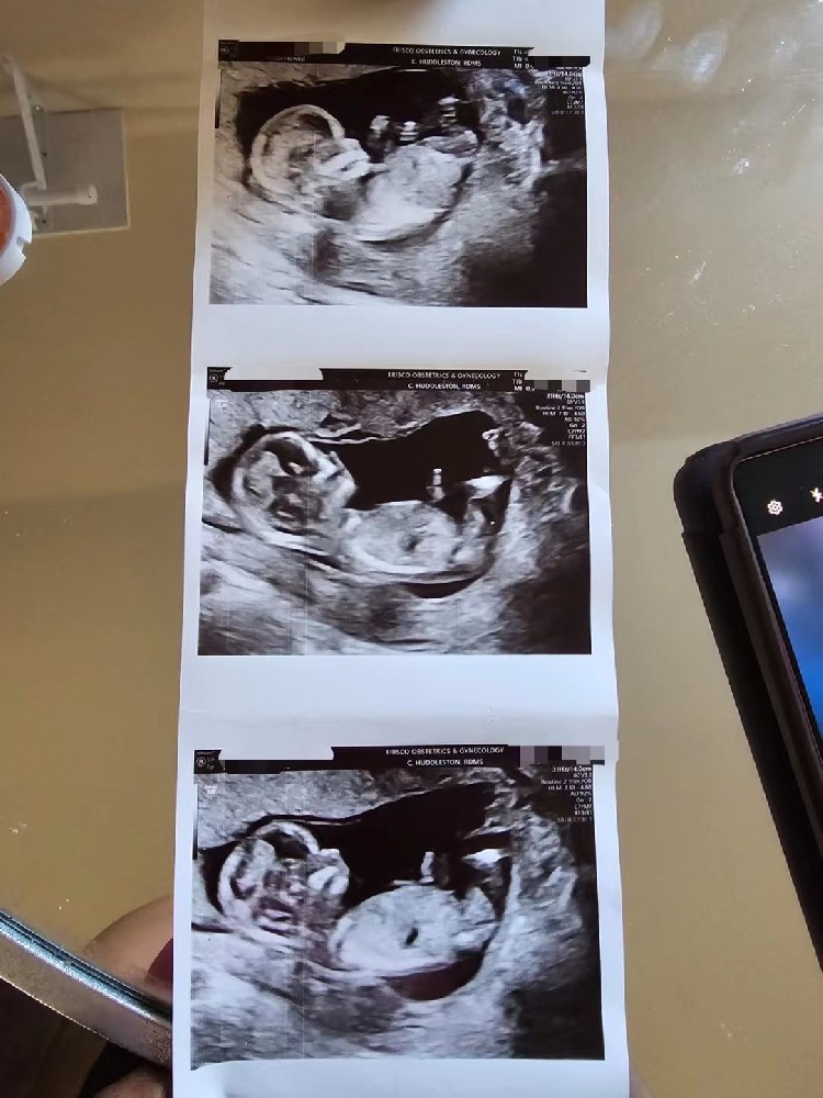 一起来看看代孕妈妈的产检超声波，宝宝已经有14cm了！